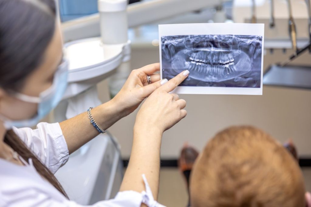 Dentist at Burlington Family Dentists explaining impacted wisdom tooth on X-ray before extraction procedure.