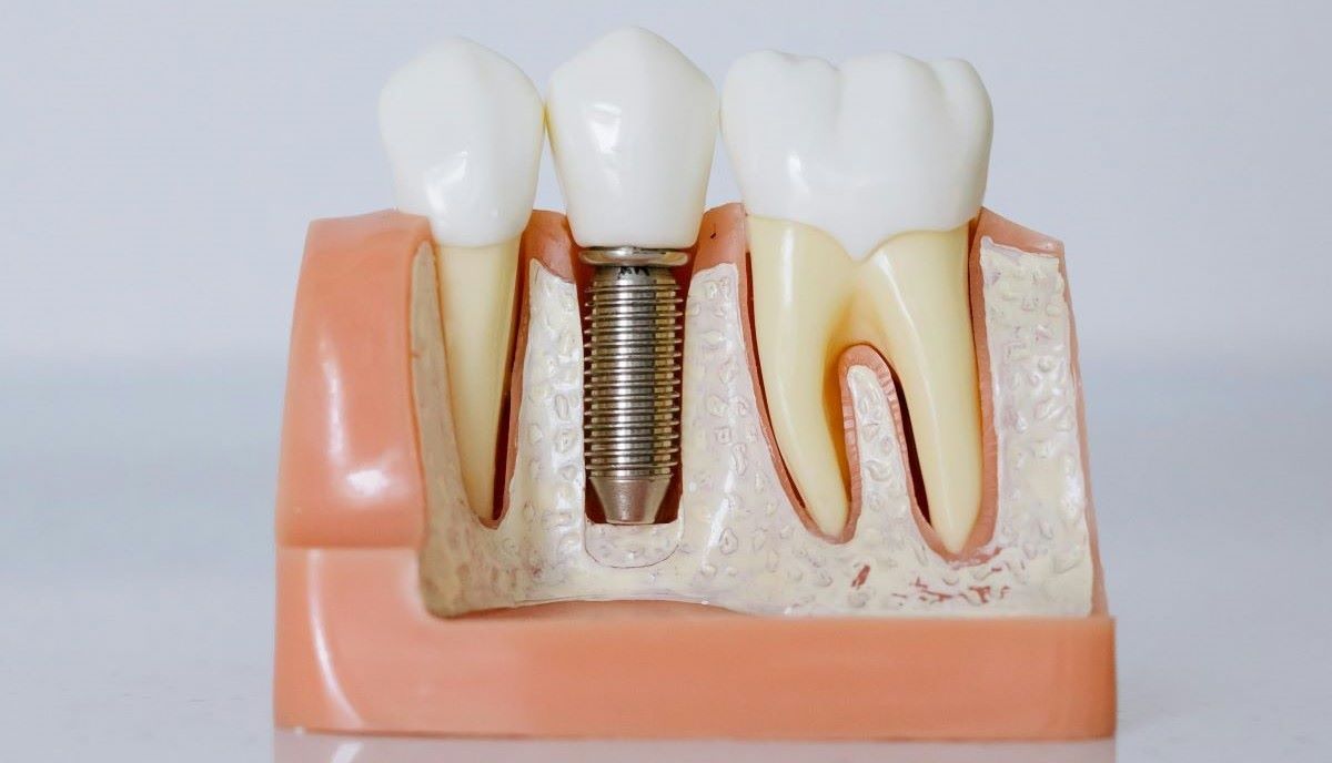 Dental Implants