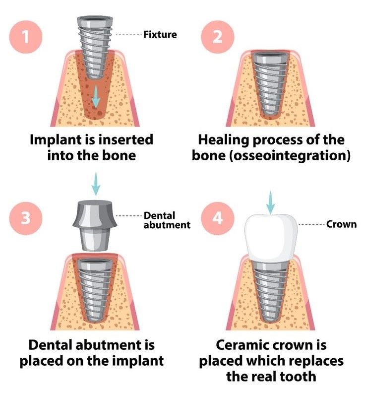 Dental Implants procedure infographic at Burlington Family Dentists in Burlington showing steps from insertion to crown