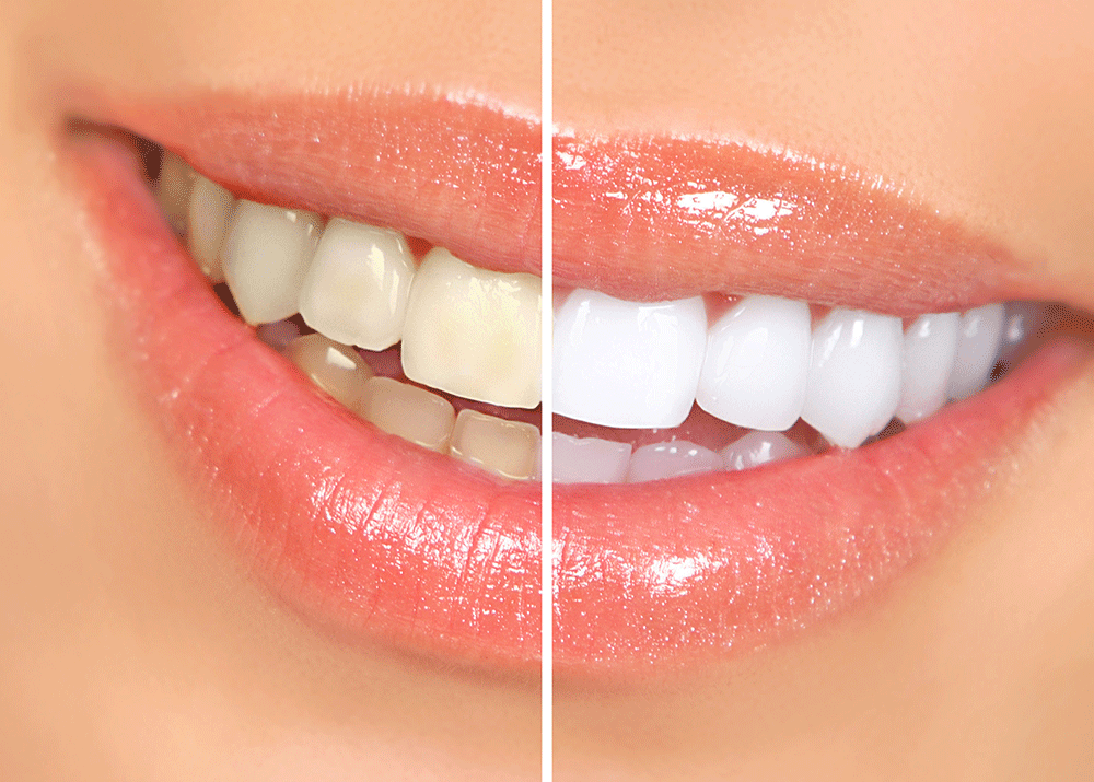 Illustration of teeth showing before and after whitening results