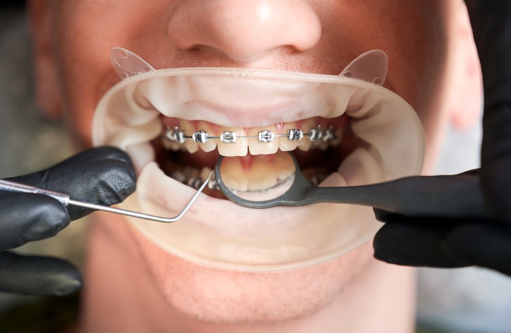 Young man with metal braces during an orthodontic checkup.
