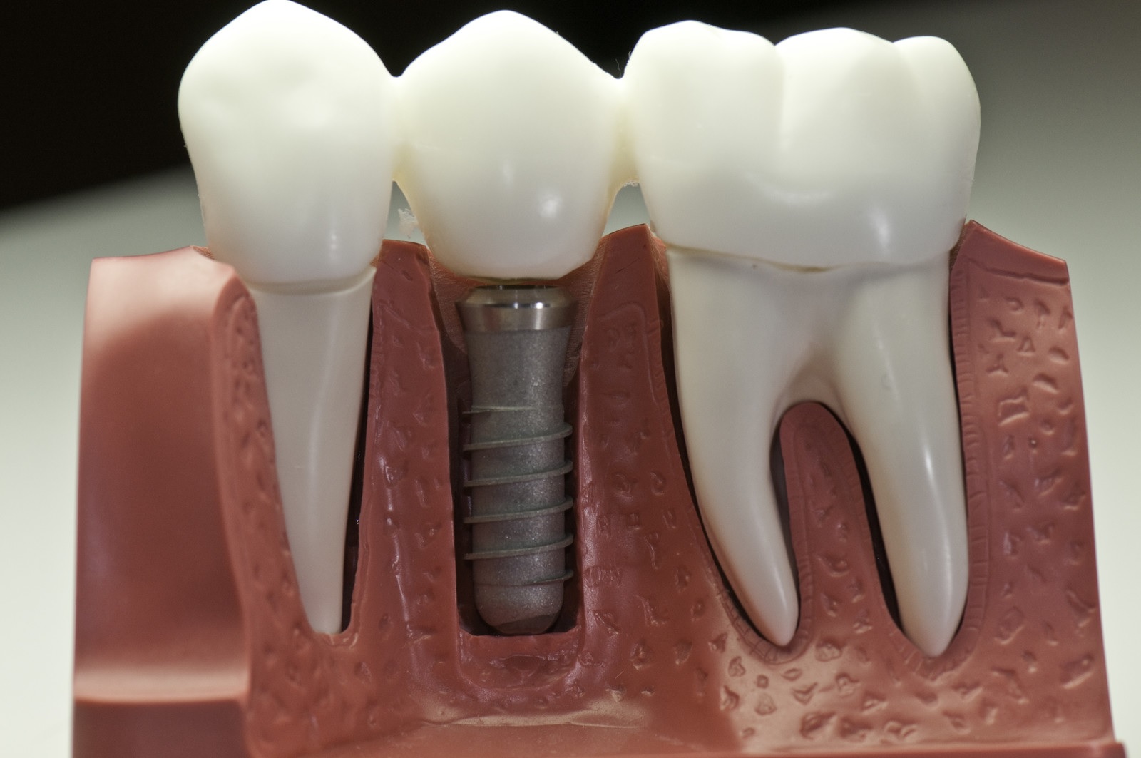 dental implants in Burlington