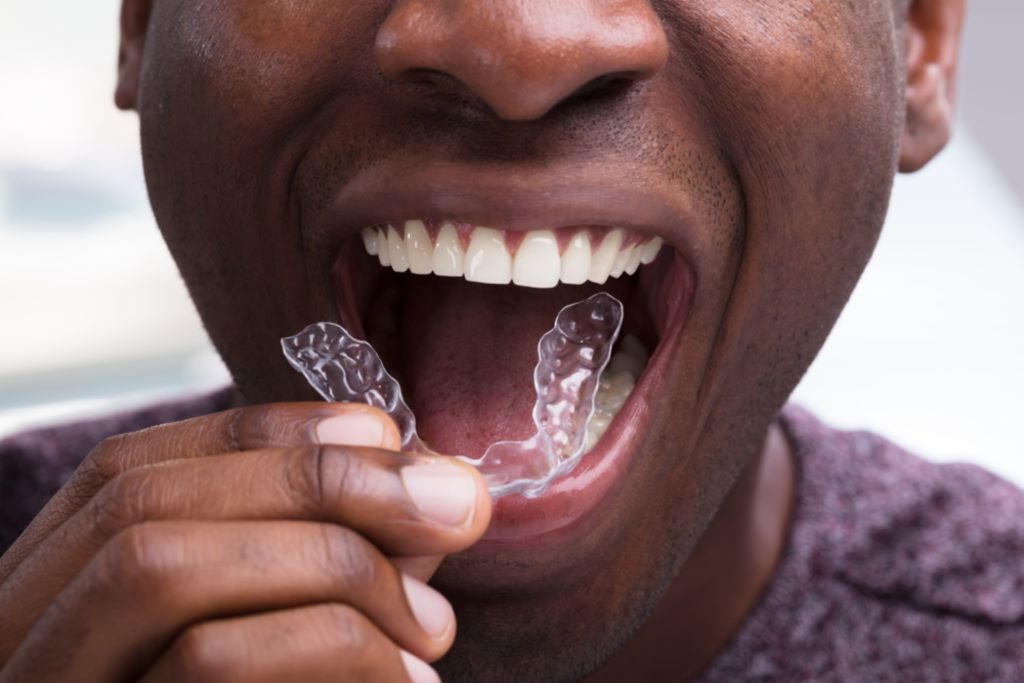 Invisalign in Burlington