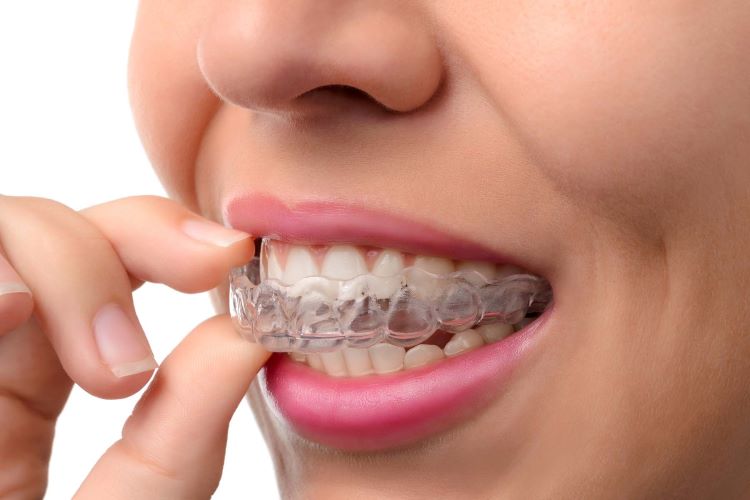 Invisalign Burlington