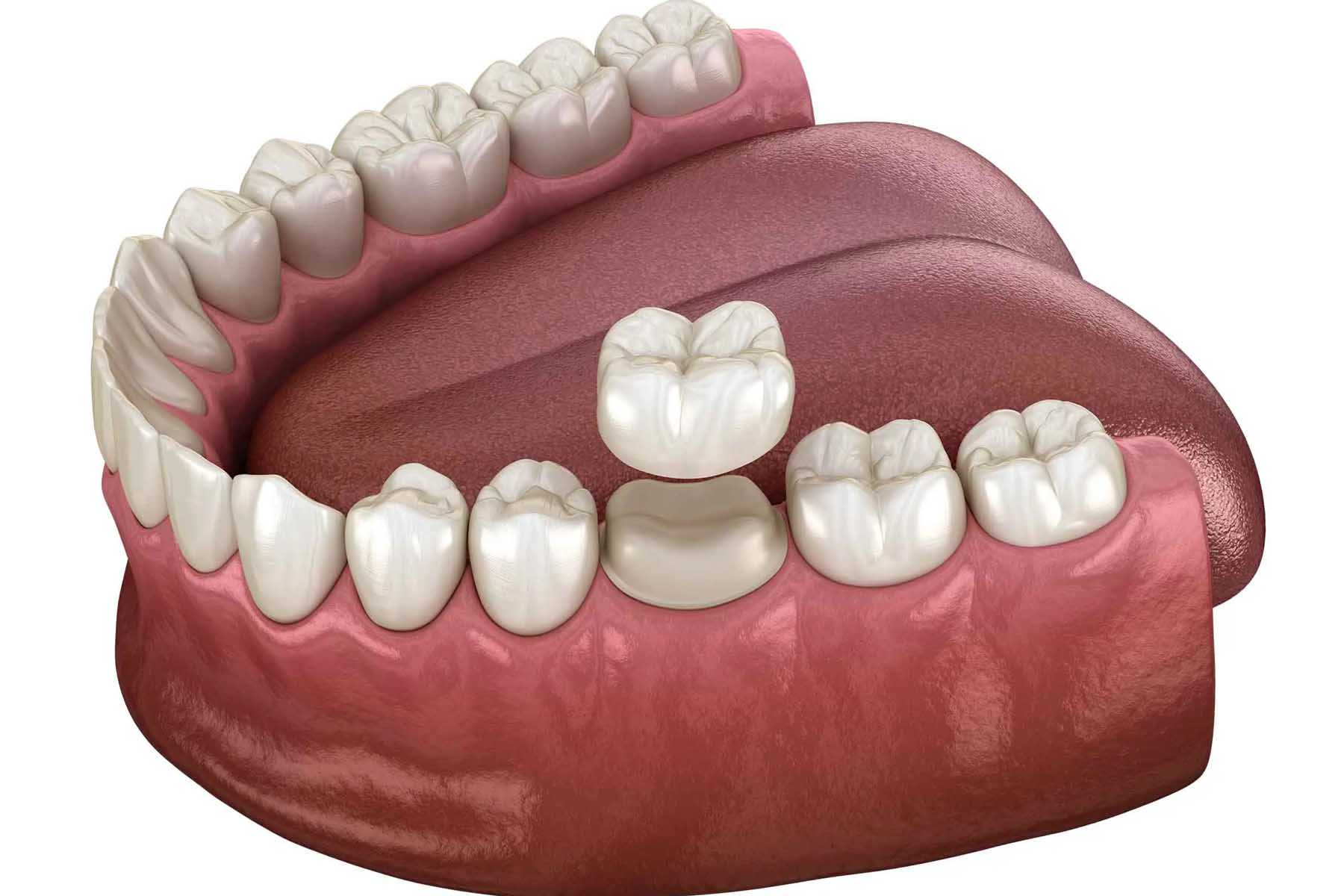 Dental Crown Procedure: What Patients in Burlington Area Need to Know